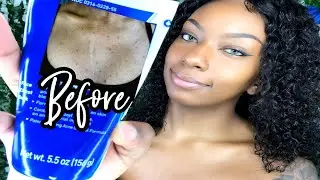 Средство от прыщей, которое спасло мне жизнь! Программа от прыщей Panoxyl Body