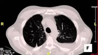 constrictive pericarditis