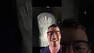 Transmetatarsal Amputation