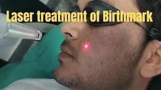 Laser treatment of birthmark| Laser treatment of Nevus of Otta| Best laser treatment in Ranchi 