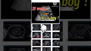 21weeks ultrasound scan। gender reveal it's a boy #baby #shorts #sonography #ytshorts #anomaly