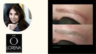 Microblading removal information