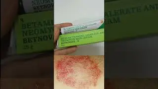 Batnovate N Cream For Fairness ? #shorts #skincare #skininfection #review