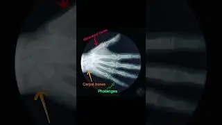 X-RAY of a hand #xray #doctor #medical #medicaleducation #medicine #lesson #viral #fyp #ninjanerd