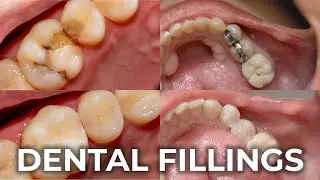 Dental Fillings | A Comprehensive Guide to Restoring Your Smile