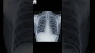 Normal lung vs Infected lungs 🫁 #lungs #chest #radiology #xray #neet #radiology #medicos #doctor