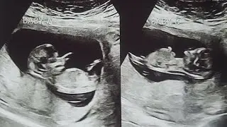 Twin Pregnancy Update! AND Some Other Exciting News!! 