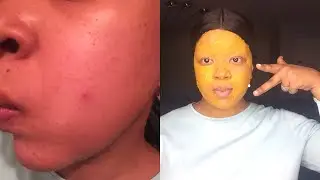 TURMERIC FACE MASK FOR ACNE HYPERPIGMENTATION AND TO FADE SCARS
