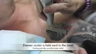 Laser tattoo removal