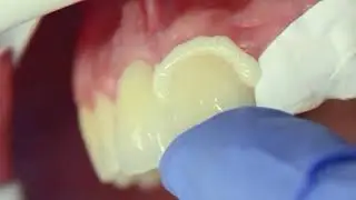 3M&trade;  RelyX Universal. Excess Cleanup Video