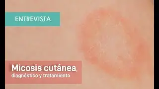 Diagnóstico y tratamiento de las micosis cutáneas.