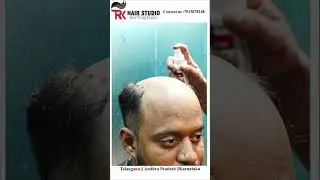 &ldquo;Instant Confidence Boost: Watch This Hair System Makeover&rdquo;
