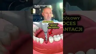 Dentysta: Trzeba Usunąć i Wstawić Implant 😳🤔
