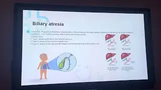 Presentation of congenital gallbladder disease 