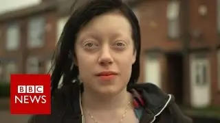 How I overcame 'stigma' of albinism - BBC News