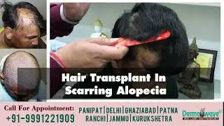 Hair Transplant In Burn Scars | Hair Transplant in Scarring Alopecia/Cicatricial Alopecia |