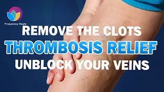 Deep Vein Thrombosis Relief | Remove the Blood Clot & Unblock Your Veins