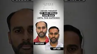 See the Power of Natural Hair Transplant | Expert Results | Before After #shorts