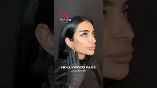 Hollywood face 💉 #jawline #faceting #lifting #lips #filler #fullface #beauty #lipfiller #makeup