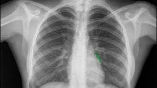 How to read a chest X-ray; easy and simplified