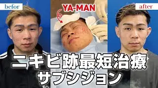 【ニキビ跡治療】サブシジョンをやったら効果ありすぎた