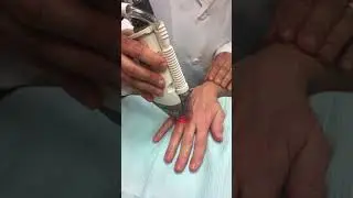 Bruce Robinson MD, NYC - Fraxel Laser Treatment / Hand Rejuvenation - Turn back the hands of time!