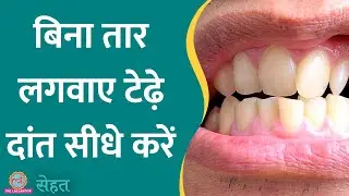 Crooked Teeth यानी टेढ़े मेढ़े दांत क्यों निकलते हैं और इससे कैसे बचें | Sehat ep 605