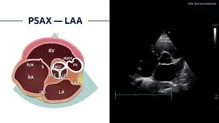 〖Echocardiography〗 PSAX - left atrial appendage 🫀📖