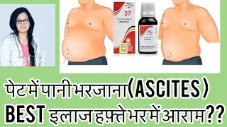 पेट मे पानी भर जाना(जलोदर)?Best Homeopathic Medicine For Ascites-By Dr rukmani Homeopathy