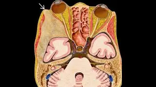 Brain Tumours (54):  Skull Lesions  أورام الجمجمة