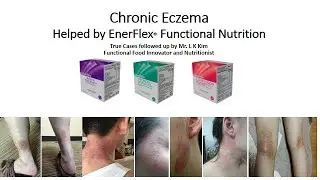 100% Natural Healing of Chronic Eczema by EnerFlex Functional Nutrition -  2019