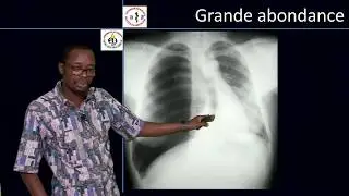 MCA Savi de Tove KM : Diagnostic Radiographique d'un pneumothorax post traumatique