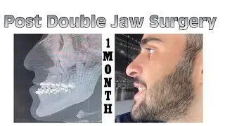 Double Jaw Surgery | Post-Op 1 Month