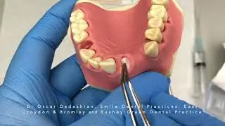Ridge preservation; Bio-Oss Collagen with Mucograft Seal