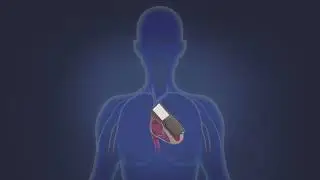 World's Smallest Pacemaker VS Conventional Pacemaker