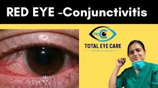 Red eye| Conjunctivitis| Total Eye Care Kolkata