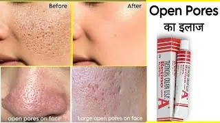 कितनी भी पुरानी Open Pores, Large Pores, Clogged Pores हो, इस इलाज से ठीक होगा (retino a, Tretinoin)