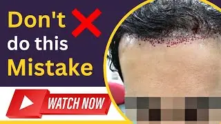 Hair Transplant Correction & Repair | Botched Hair Transplant | Bad Hairline Repair |Dr Shaiil Satya