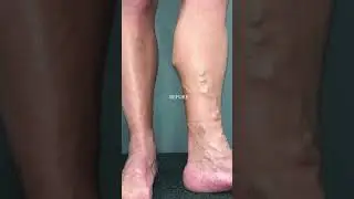 ANTES E DEPOIS VARIZES DE GROSSO CALIBRE - TRATAMENTO 100% A LASER SEM CORTES