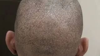 FUE scar on African American Patient by Los Gatos Hair Transplant