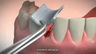 Tooth Extraction and Socket Preservation in San Diego