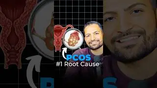 #1 PCOS Root Cause?