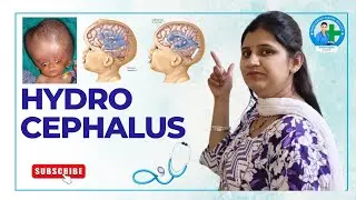 Hydrocephalus | Pooja Mam #Hydrocehauls #easynursing #nursingschool #viralvideos