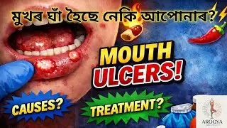Mouth Ulcer And It's Easy Treatment In Assamese 3 |Mouth Ulcer Causes,Symptoms|মুখৰ ঘাঁৰ সহজ চিকিৎসা