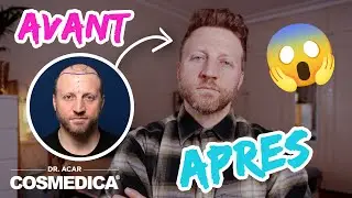 Update de ma Seconde Greffe de Cheveux chez Cosmedica à Istanbul - les résultats 11 MOIS après!