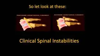 What is Spinal Instability? (Spinal Ligament Injuries)