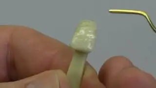Composite restoration avoid incisal fracture - XBD