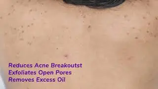 Dermistry 1% Salicylic Acid Back Acne Prone Oily Skin Exfoliating Body Wash Neem Zinc Niacinamide