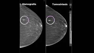 Casos Clínicos - Diagnóstico por Tomosintesis