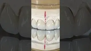 Amber Press Incisors #lsk121shorts #dentistry #teeth